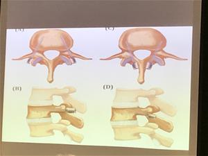 脊椎打釘子的作法